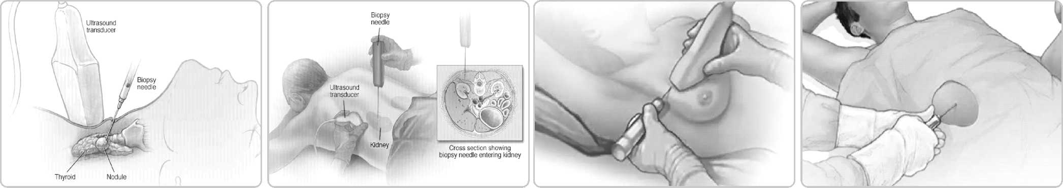 1735629564524557.jpg FULL-AUTO Biopsy needles6.jpg