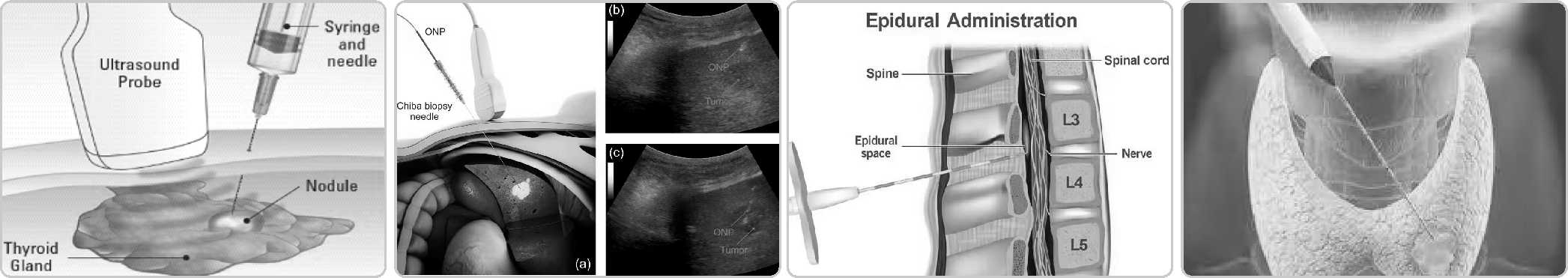 1735635076407193.jpg BIOPSY NEEDLE6.jpg